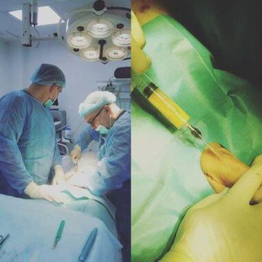 عضو تناسل کا گاڑھا ہونا سرجری کی مدد سے ممکن ہے۔